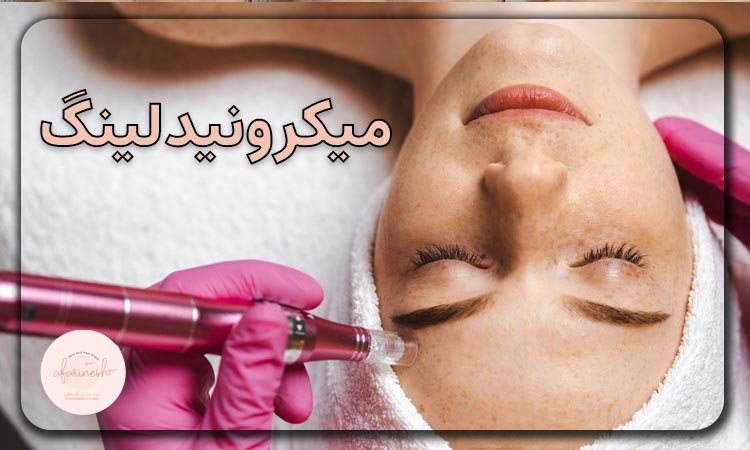 میکرونیدلینگ صورت چیست