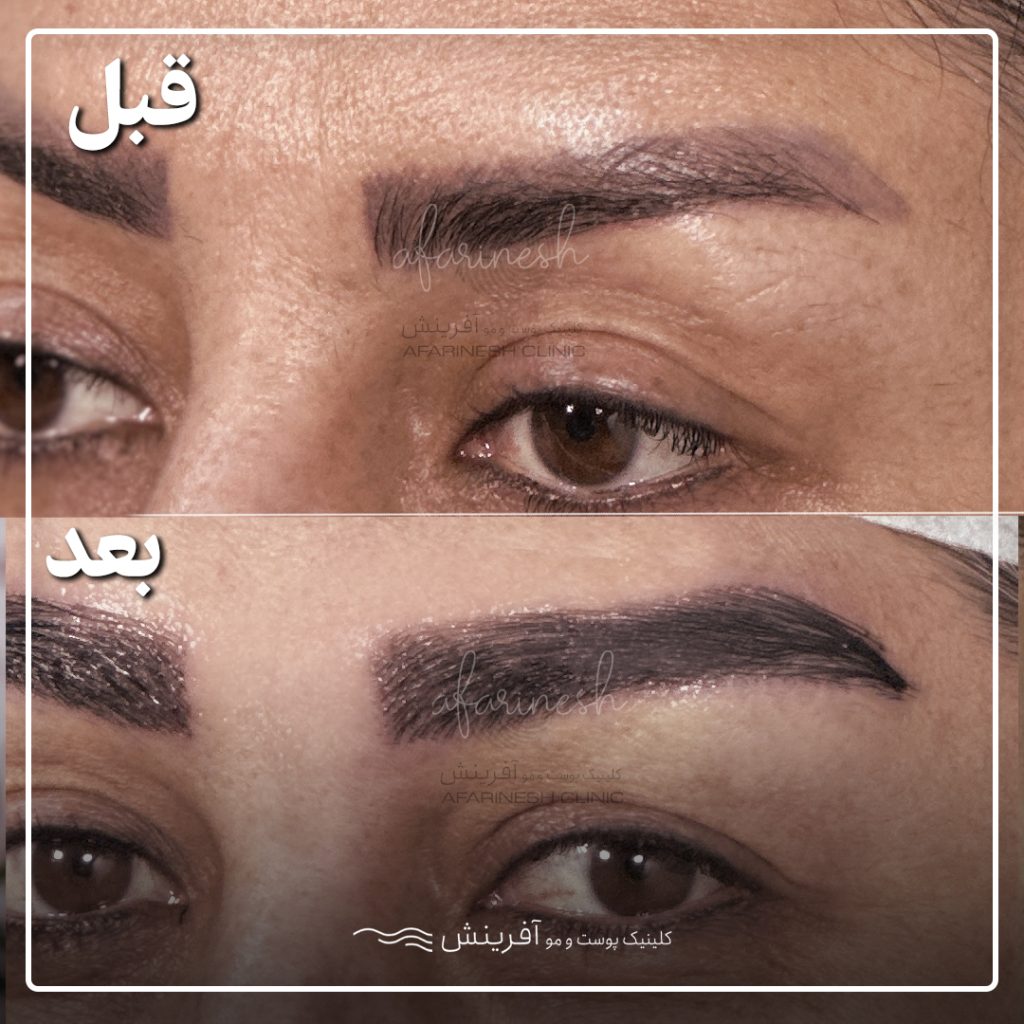 نمونه کاشت ابرو
