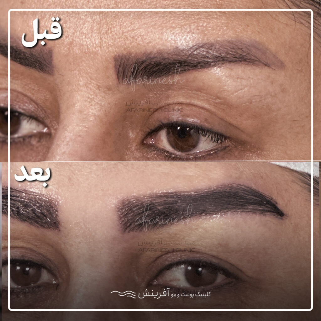 نمونه کاشت ابرو