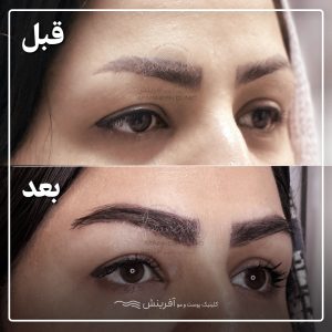 عکس قبل از کاشت ابرو