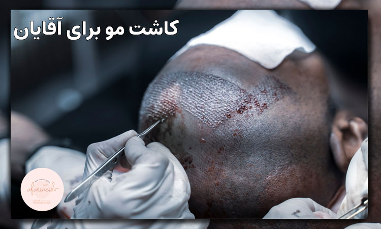 کاشت مو برای مردان