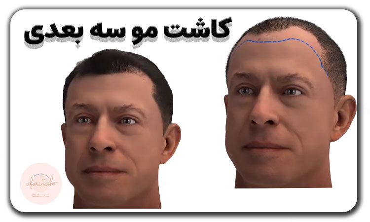 کاشت مو سه بعدی