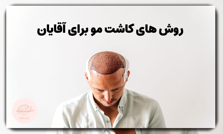 روش های کاشت مو برای آقایان
