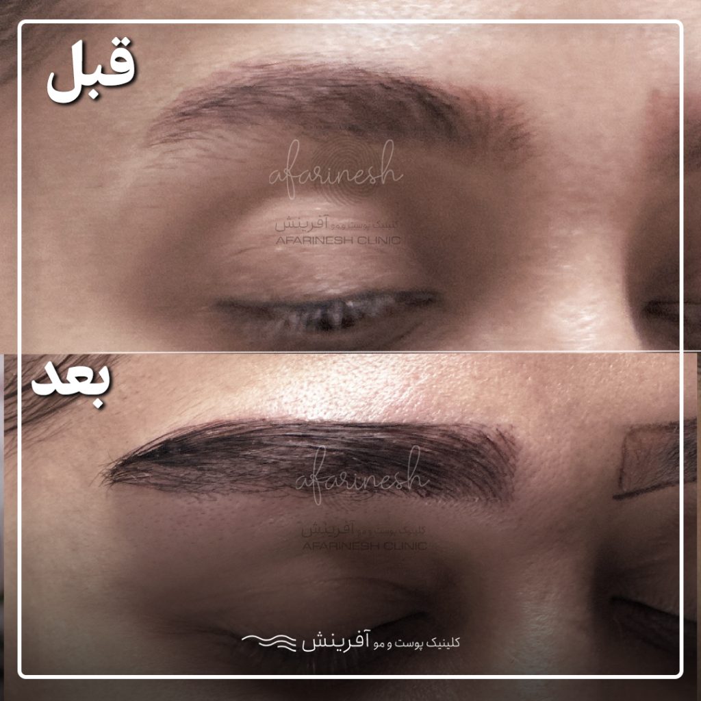 عکس کاشت ابرو قبل و بعد از کاشت