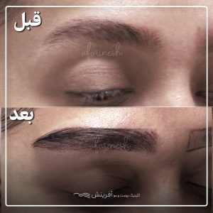 عکس کاشت ابرو قبل و بعد از کاشت