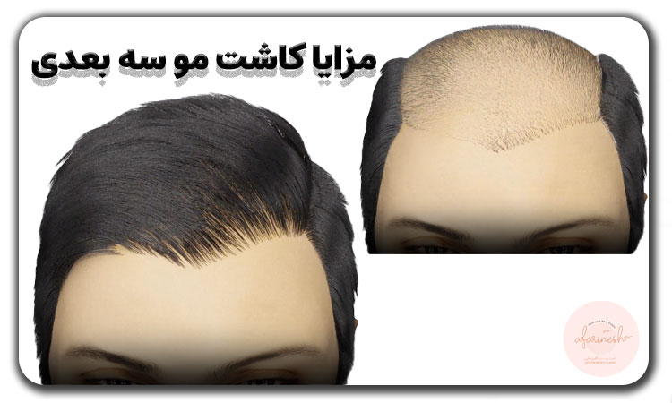 مزایا کاشت مو سه بعدی