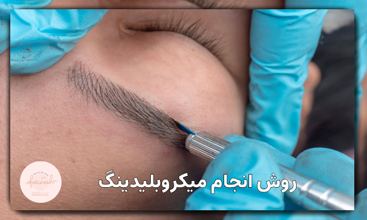 روش انجام میکروبلیدینگ