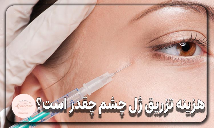 هزینه تزریق ژل چشم