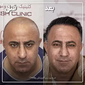 نمونه قبل و بعد از کاشت مو