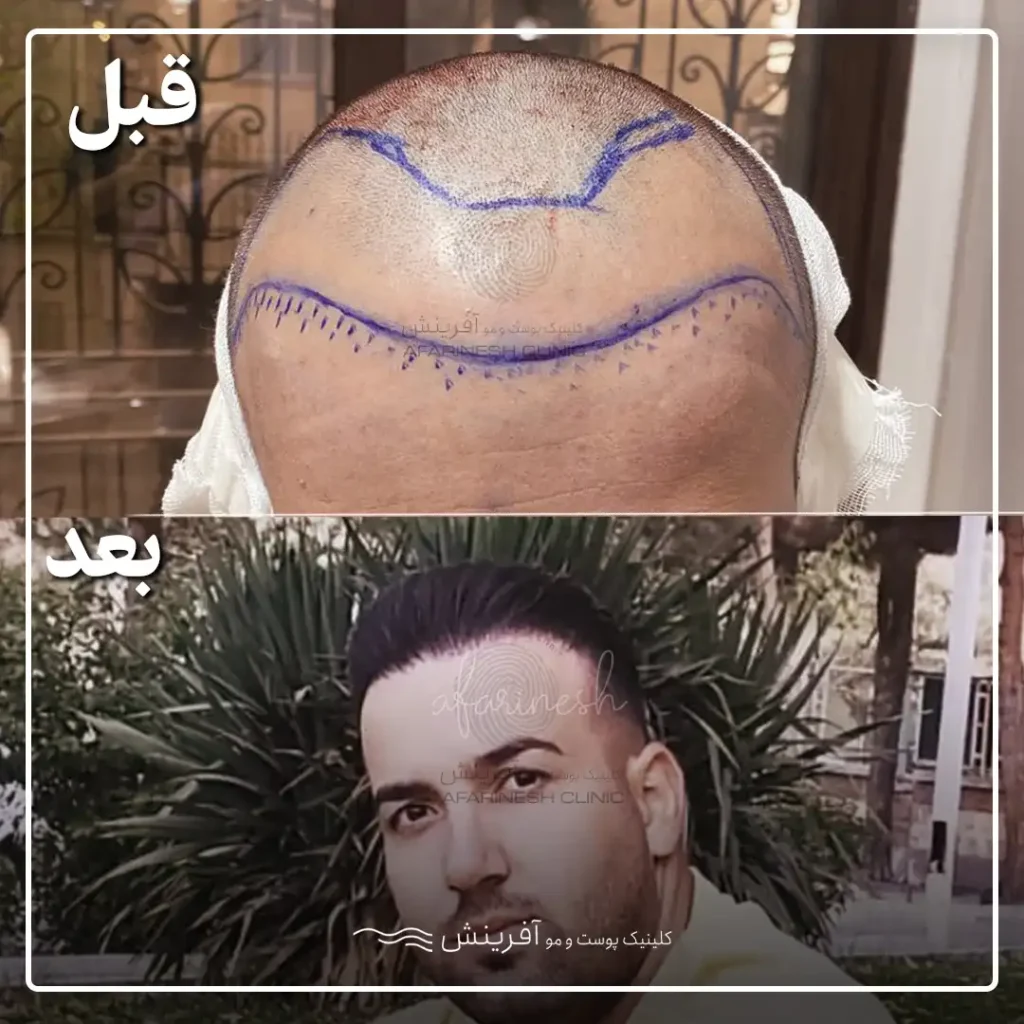 عکس قبل و بعد از کاشت مو در 3 ماه بعد