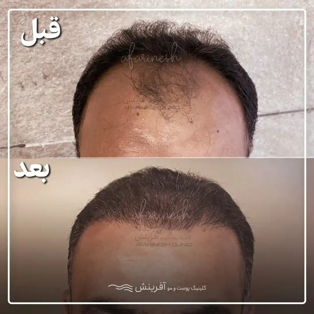 عکس قبل و بعد از کاشت مو پیشانی خالی
