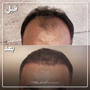عکس قبل و بعد از کاشت مو پیشانی خالی