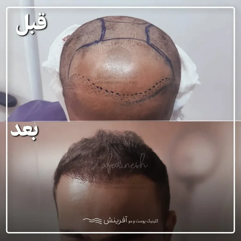 عکس قبل و بعد کاشت مو کله طاس