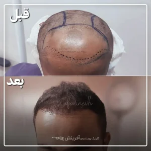 عکس قبل و بعد کاشت مو کله طاس