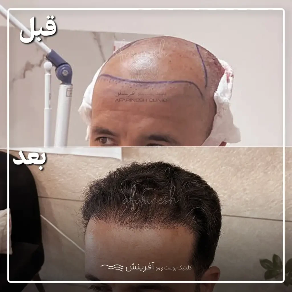 عکس قبل کاشتن مو