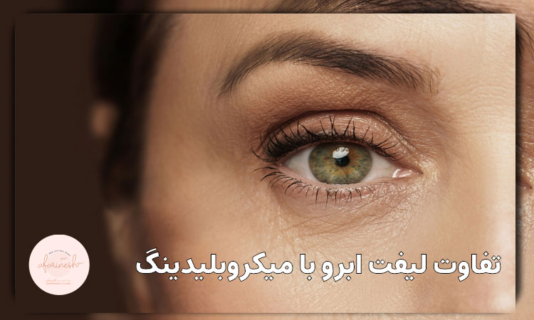 تفاوت لیفت ابرو با میکروبلیدینگ
