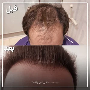 کاشتن مو طبیعی قبل و بعد