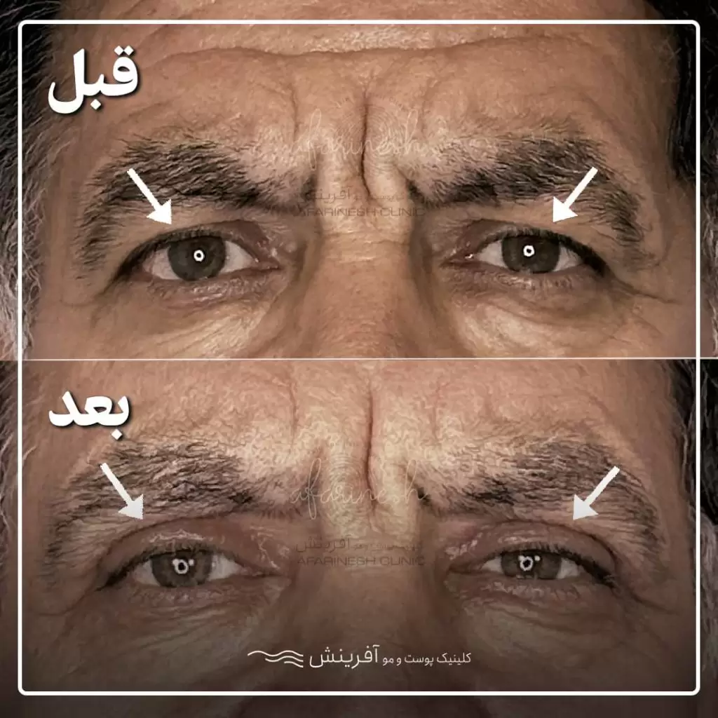 قبل و بعد بلفاروپلاستی دو پلک بالا