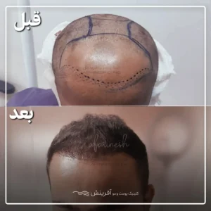 عکس قبل و بعد کاشت مو کله طاس