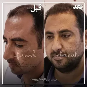 قبل و بعد کاشتن مو