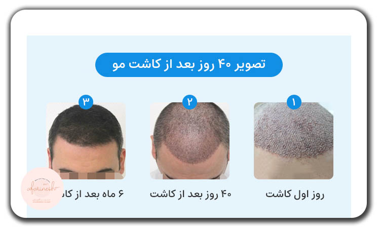عکس کاشت مو بعد از ۴۰ روز
