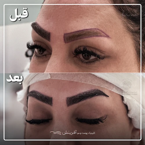 کاشت ابرو طبیعی