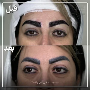 تصاویر کاشت ابرو قبل و بعد از هنرمندان