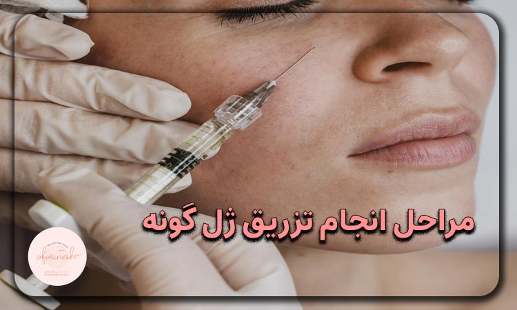 مراحل انجام تزریق ژل گونه
