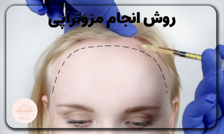 انجام مزوتراپی