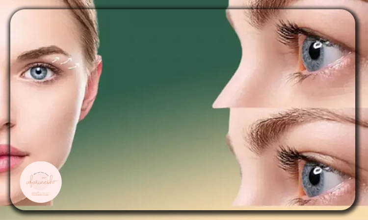 مزایای بلفاروپلاستی