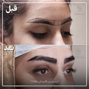 گالری تصاویر کاشت ابرو قبل و بعد