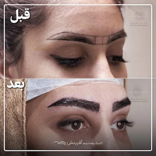 گالری تصاویر کاشت ابرو قبل و بعد