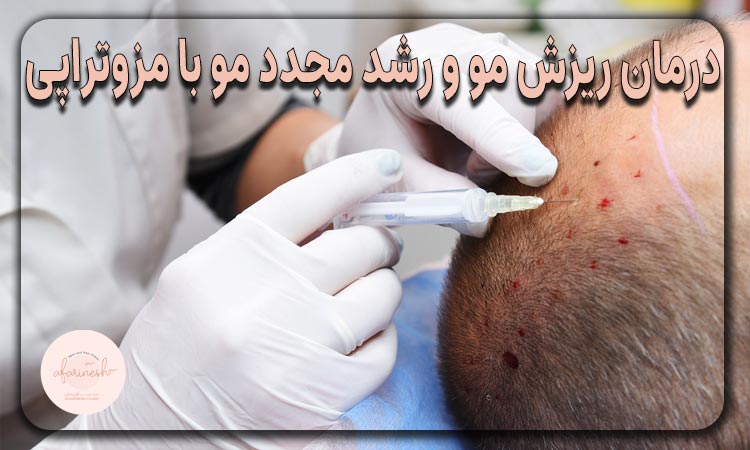 درمان ریزش مو و رشد مجدد مو با مزوتراپی