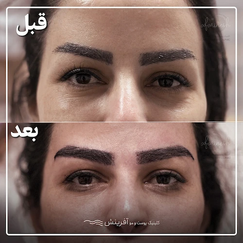نمونه قبل و بعد از کاشت مو در ناحیه ابرو