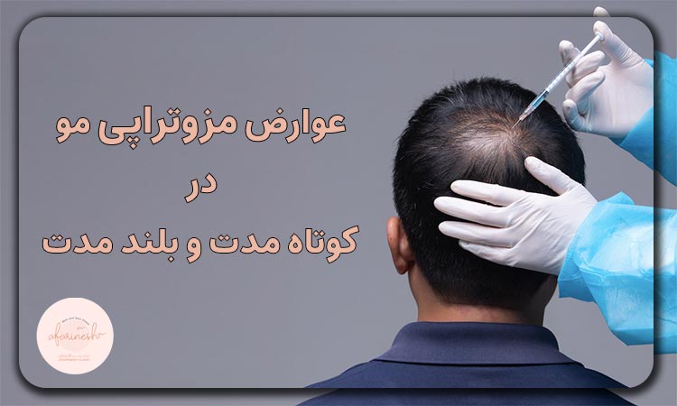 عوارض مزوتراپی مو در بلند مدت و کوتاه مدت