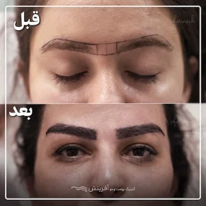 طراحی و کاشت ابرو قبل و بعد