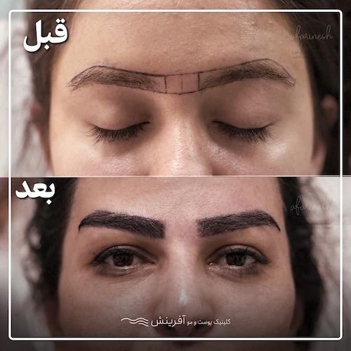 طراحی و کاشت ابرو قبل و بعد