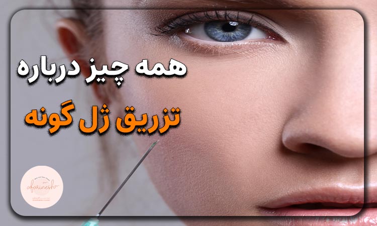 تزریق ژل به گونه