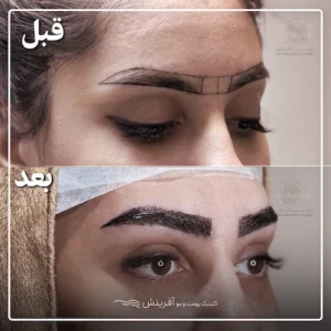 گالری تصاویر کاشت ابرو قبل و بعد
