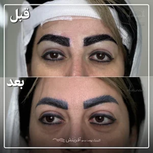 تصاویر کاشت ابرو قبل و بعد از هنرمندان