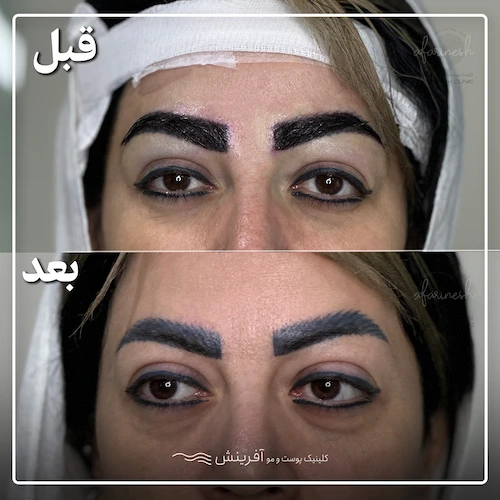تصاویر کاشت ابرو قبل و بعد از هنرمندان