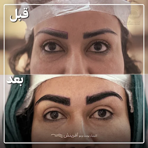 نمونه کاشت ابرو پهن و دخترانه