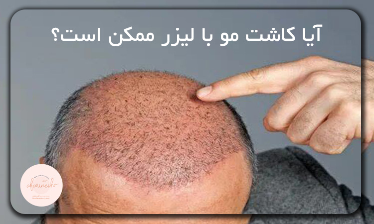 آیا کاشت مو با لیزر ممکن است؟