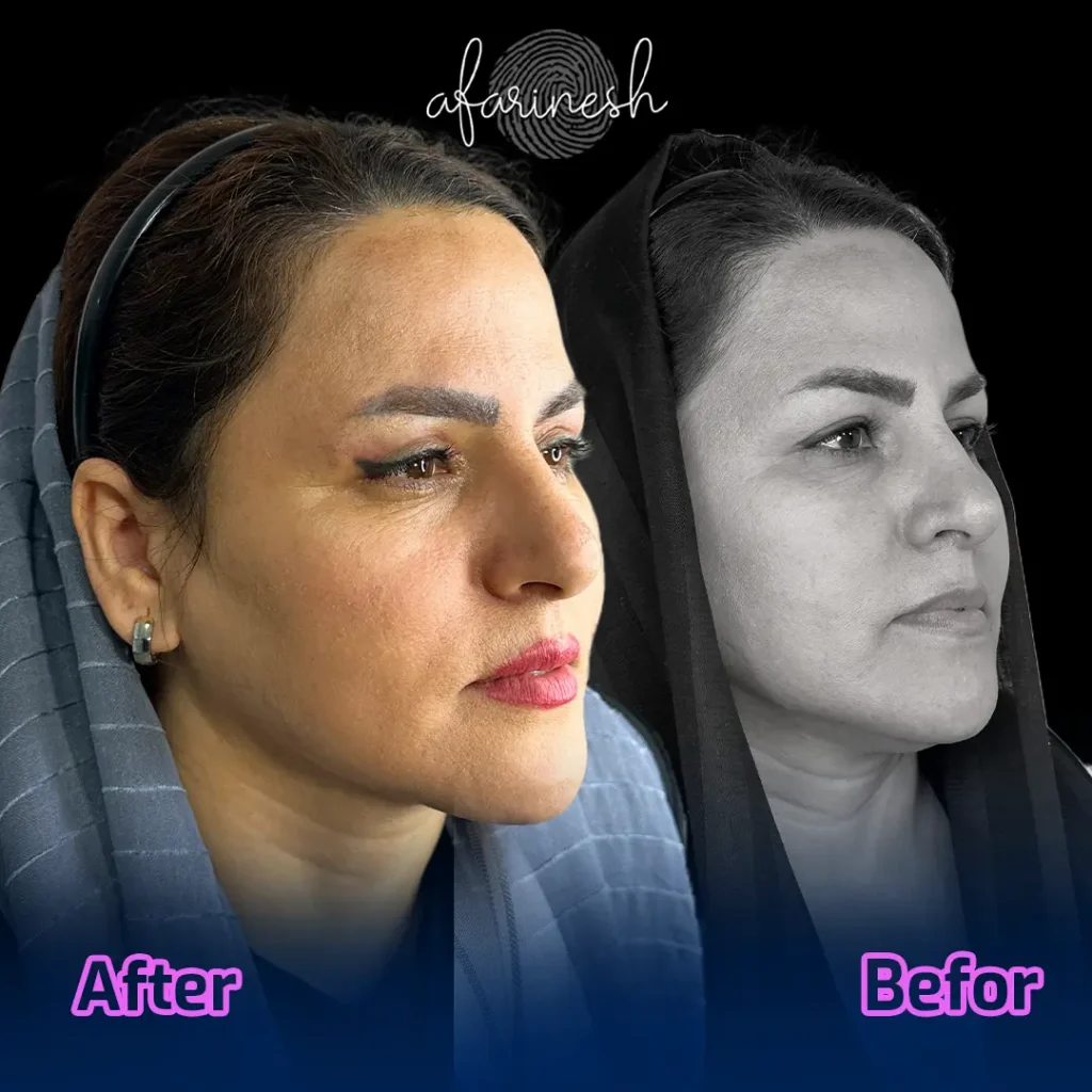 عکسهای عمل بلفاروپلاستی
