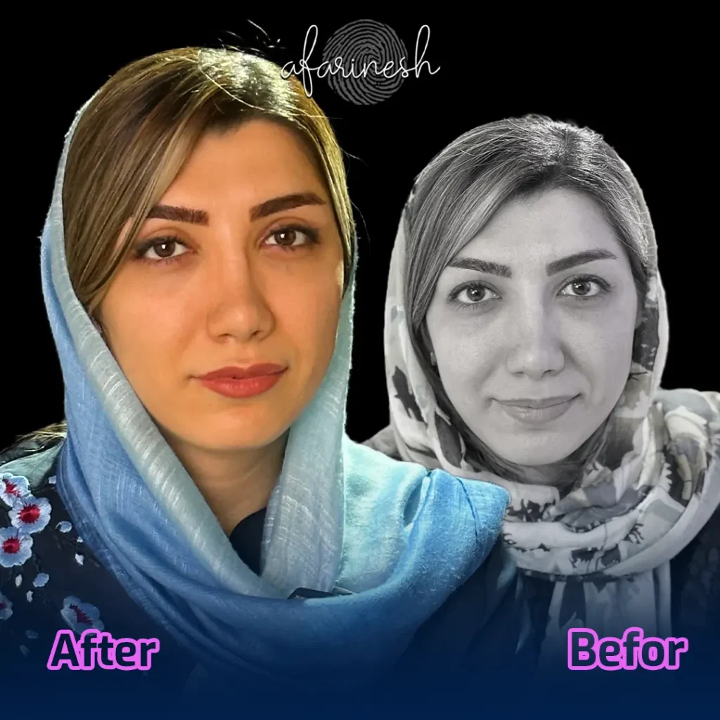 عکس قبل و بعد عمل افتادگی پلک