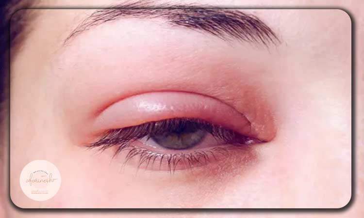 عکس ورم صورت بعد از کاشت ابرو