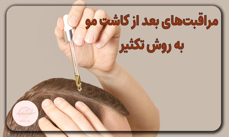 مراقبتهای بعد از کاشت مو به روش تکثیر