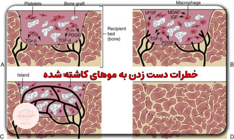 خطرات دست زدن به موهای کاشته شده