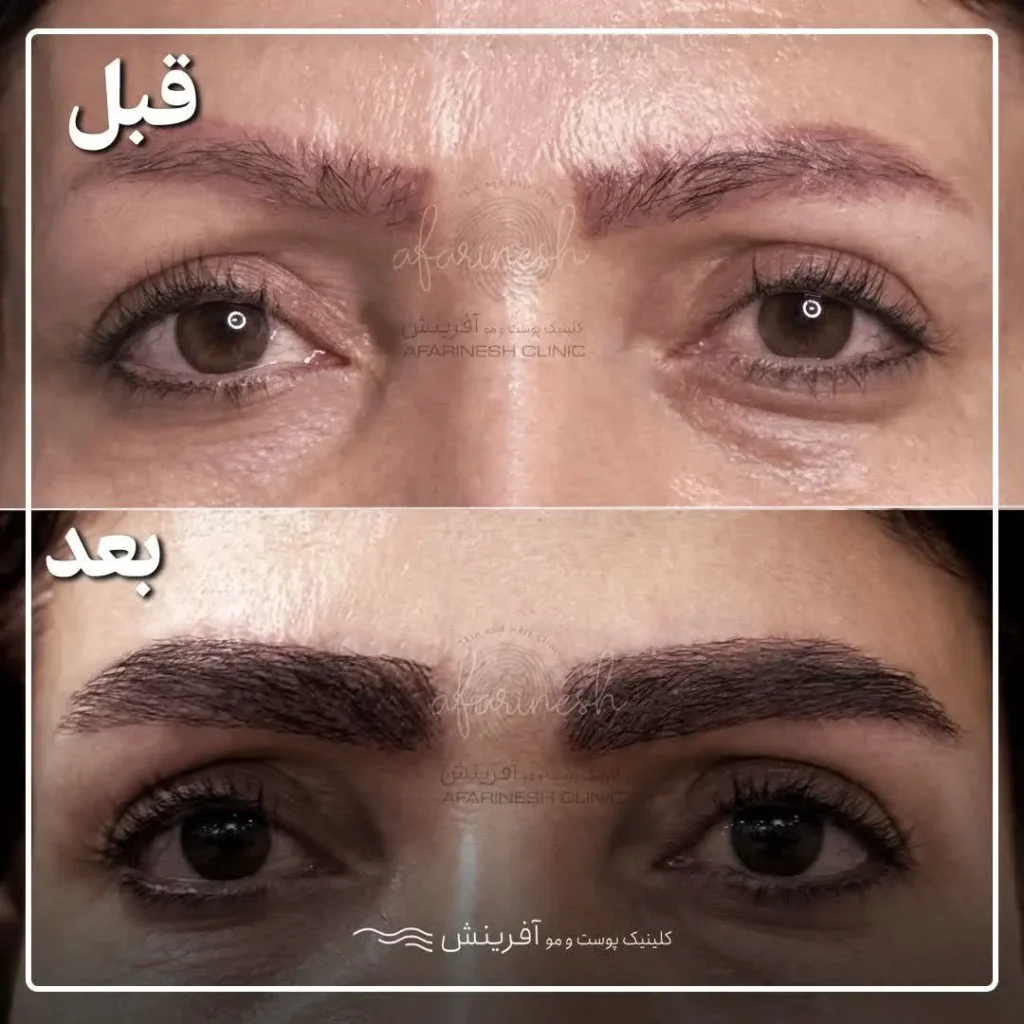 نمونه عکس قبل و بعد کاشت ابرو