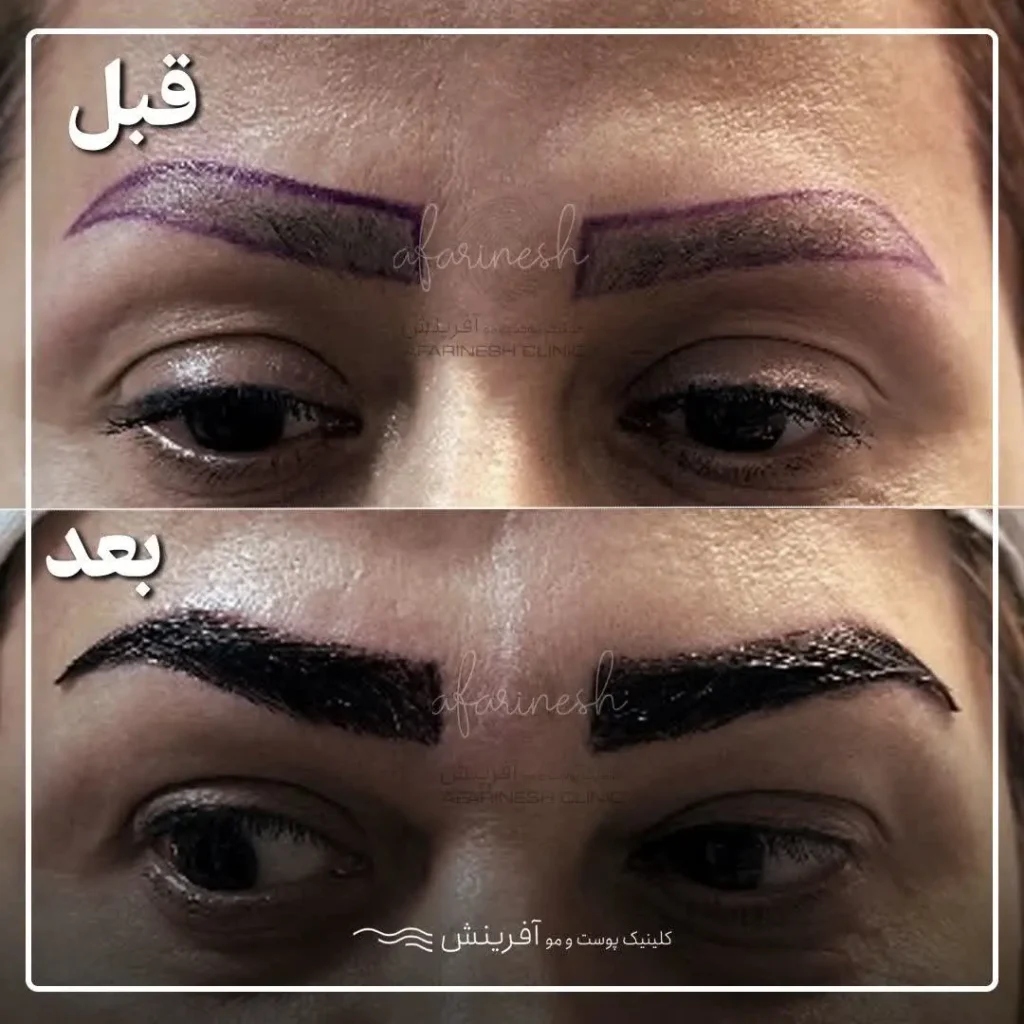 مثالی از عکس قبل و بعد کاشت ابرو